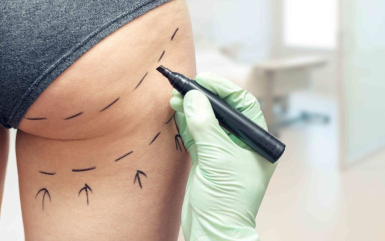 Ανόρθωση Γλουτών – Αποκτήστε καλοσχηματισμένους, νεανικούς γλουτούς